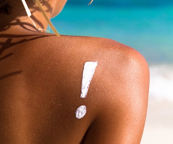 Sunburnt? Heal faster—and reduce redness—with these tips