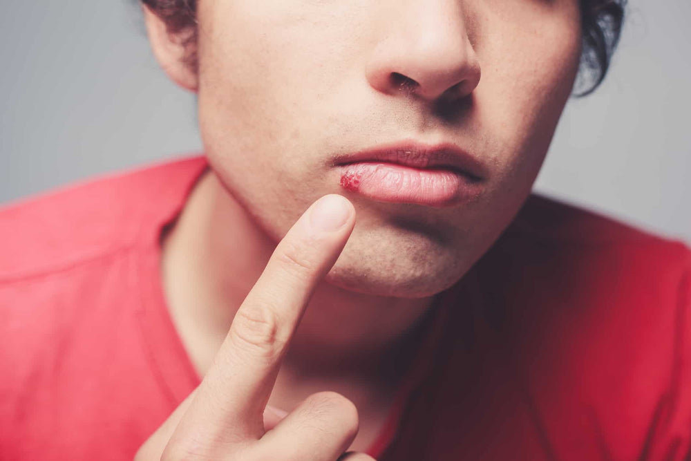 Effective Cold Sore Remedies: Your Ultimate Guide to Prevention and Quick Relief
