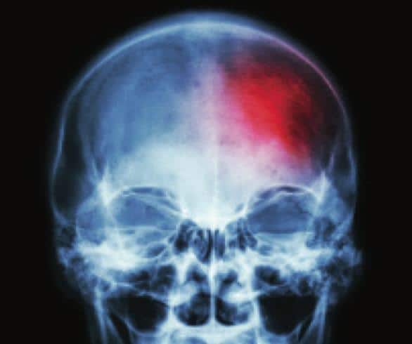 Vitamin B12 and C: Your Allies in the Fight Against Stroke