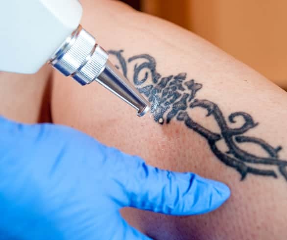 Should you consider tattoo removal?
