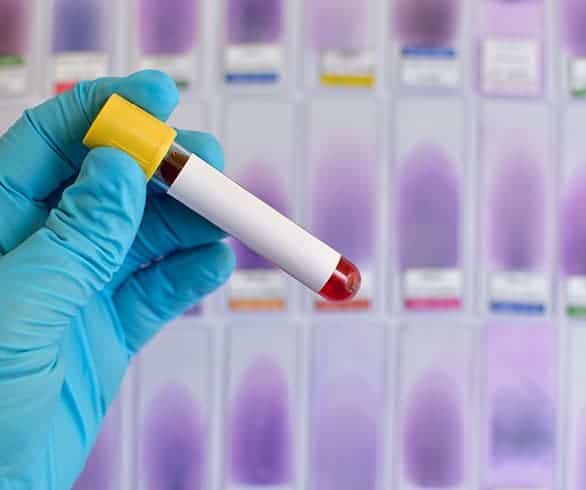 STI testing in men is lacking, according to survey