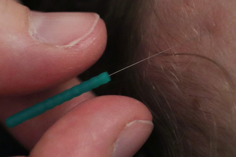 Urgent Health Alert: Montreal Acupuncturist’s Clients at Risk of Hepatitis and HIV