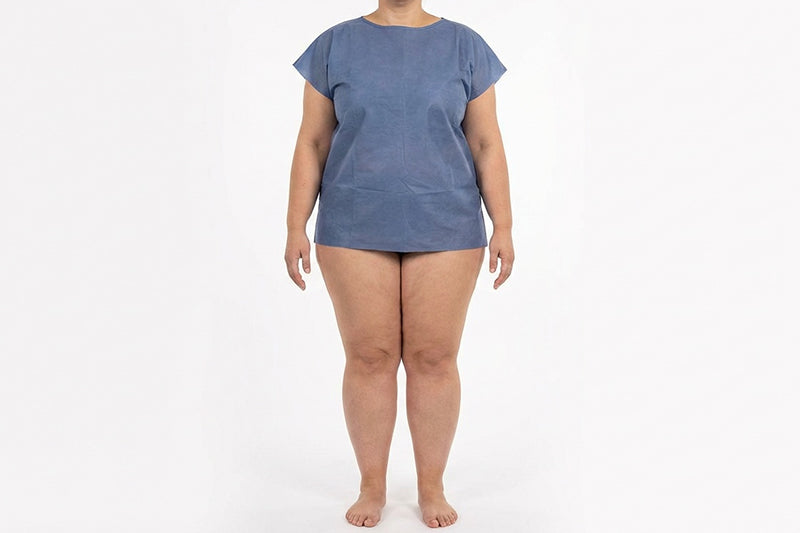 What Is Lipedema? Symptoms, Causes, Diagnosis and Care