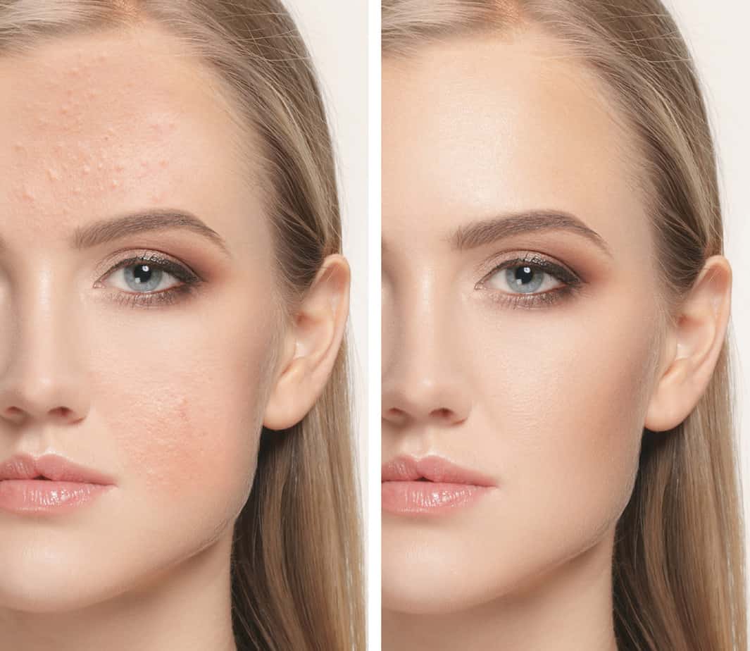 Adult acne control, treatment using Ayurvedic Recipes