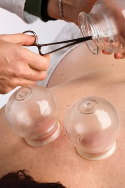 Vacuum cupping