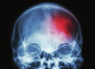 Vitamin B12 and C: Your Allies in the Fight Against Stroke
