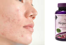 Acne No More