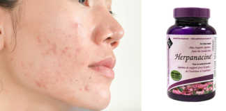 Acne No More