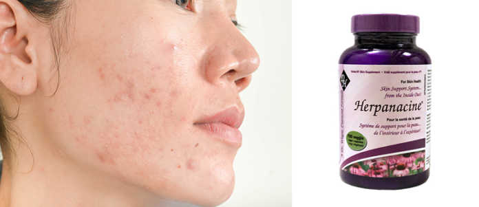 Acne No More