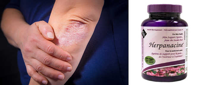 Combat Eczema, Psoriasis, Hives and Itching