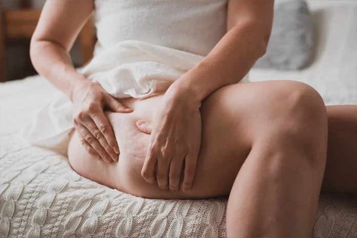 pycnogenol-cellulite-reduction